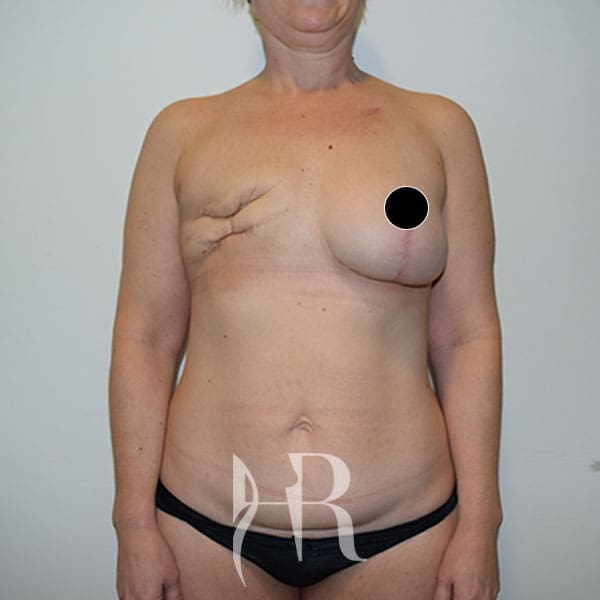 HR Plastic Surgery - Breast Reconstruction patient before 7